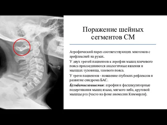 Поражение шейных сегментов СМ Атрофический парез соответствующих миотомов с арефлексией на руках.