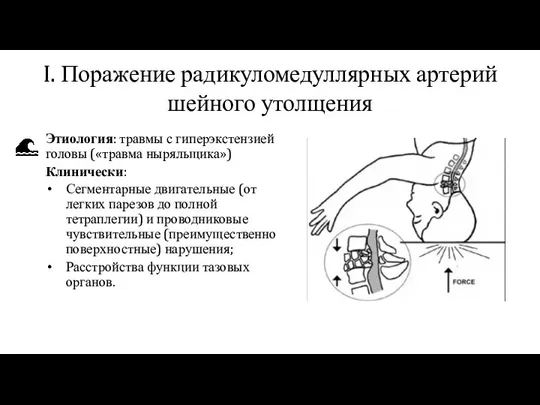 I. Поражение радикуломедуллярных артерий шейного утолщения Этиология: травмы с гиперэкстензией головы («травма