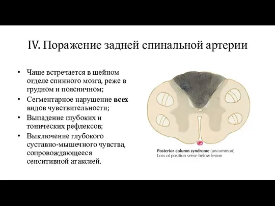 IV. Поражение задней спинальной артерии Чаще встречается в шейном отделе спинного мозга,