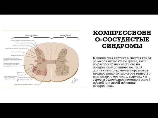 КОМПРЕССИОННО-СОСУДИСТЫЕ СИНДРОМЫ Клиническая картина меняется как от размеров инфаркта по длине, так