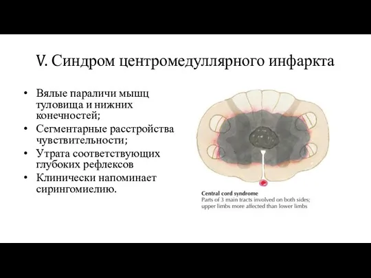 V. Синдром центромедуллярного инфаркта Вялые параличи мышц туловища и нижних конечностей; Сегментарные