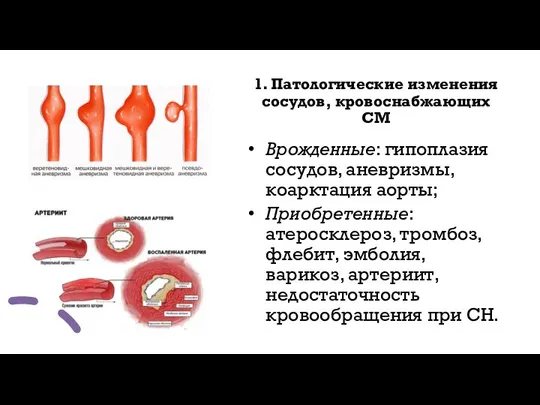 1. Патологические изменения сосудов, кровоснабжающих СМ Врожденные: гипоплазия сосудов, аневризмы, коарктация аорты;