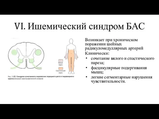 VI. Ишемический синдром БАС Возникает при хроническом поражении шейных радикуломедуллярных артерий Клинически: