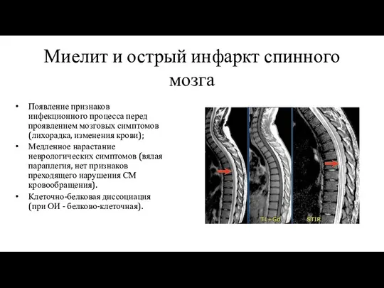 Миелит и острый инфаркт спинного мозга Появление признаков инфекционного процесса перед проявлением