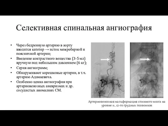 Селективная спинальная ангиография Через бедренную артерию в аорту вводится катетер → исток