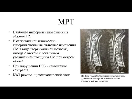 МРТ Наиболее информативны снимки в режиме Т2. В саггитальной плоскости - гиперинтенсивные