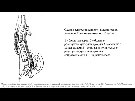 Схема распространенности ишемических изменений спинного мозга от D5 до S4 1 –