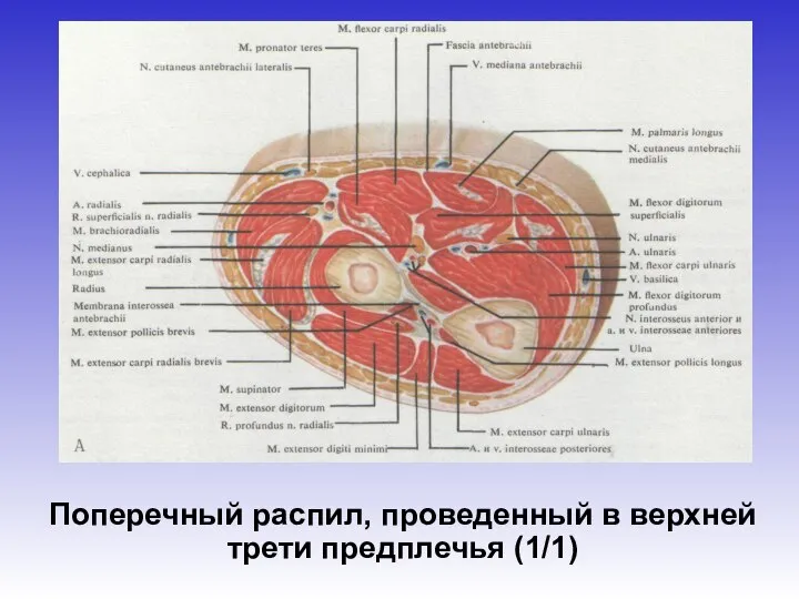 Поперечный распил, проведенный в верхней трети предплечья (1/1)