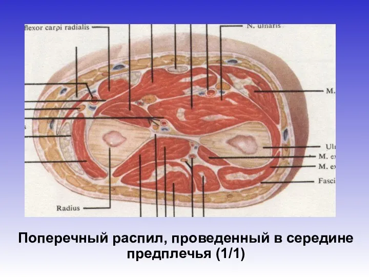 Поперечный распил, проведенный в середине предплечья (1/1)