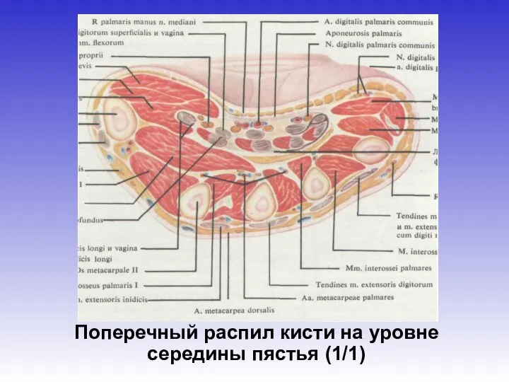 Поперечный распил кисти на уровне середины пястья (1/1)