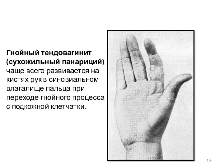 Гнойный тендовагинит (сухожильный панариций) чаще всего развивается на кистях рук в синовиальном