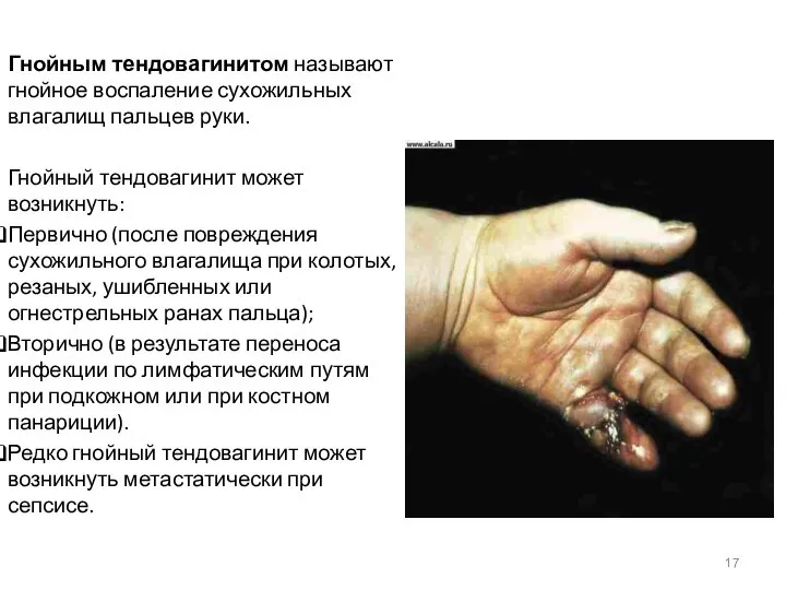 Гнойным тендовагинитом называют гнойное воспаление сухожильных влагалищ пальцев руки. Гнойный тендовагинит может