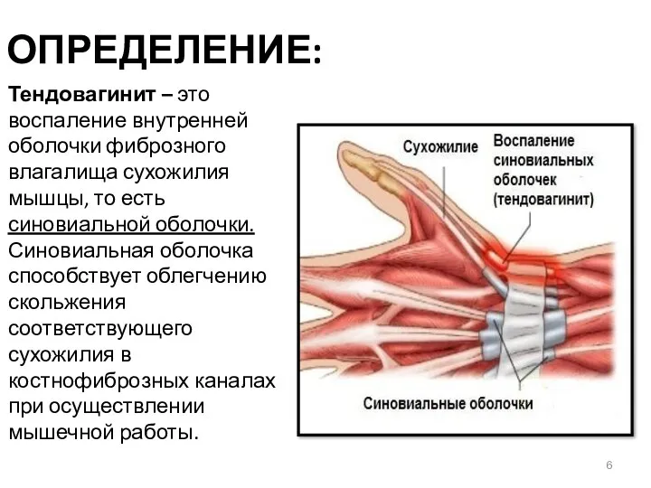 ОПРЕДЕЛЕНИЕ: Тендовагинит – это воспаление внутренней оболочки фиброзного влагалища сухожилия мышцы, то