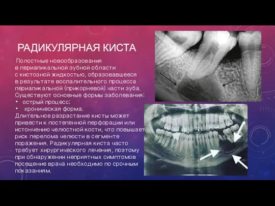 РАДИКУЛЯРНАЯ КИСТА Полостные новообразования в периапикальной зубной области с кистозной жидкостью, образовавшееся