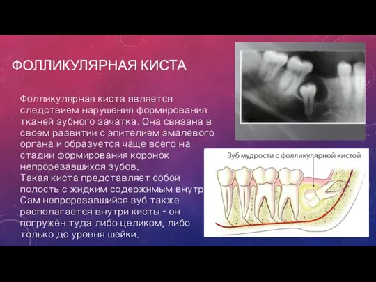 ФОЛЛИКУЛЯРНАЯ КИСТА Фолликулярная киста является следствием нарушения формирования тканей зубного зачатка. Она