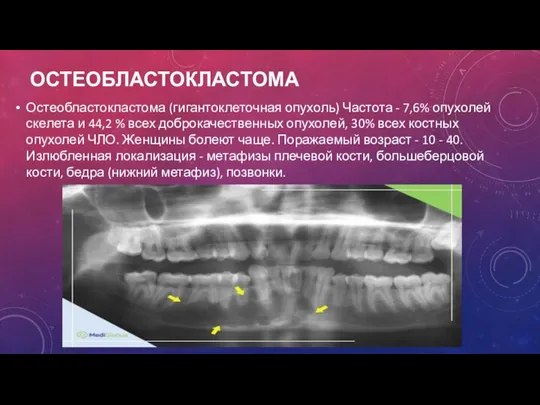 ОСТЕОБЛАСТОКЛАСТОМА Остеобластокластома (гигантоклеточная опухоль) Частота - 7,6% опухолей скелета и 44,2 %