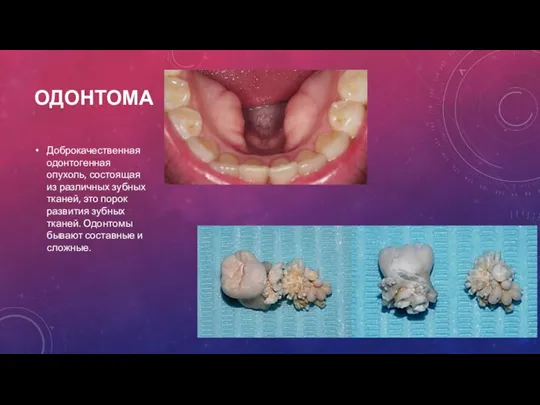 ОДОНТОМА Доброкачественная одонтогенная опухоль, состоящая из различных зубных тканей, это порок развития