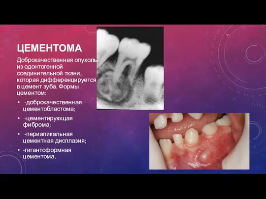 ЦЕМЕНТОМА Доброкачественная опухоль из одонтогенной соединительной ткани, которая дифференцируется в цемент зуба.