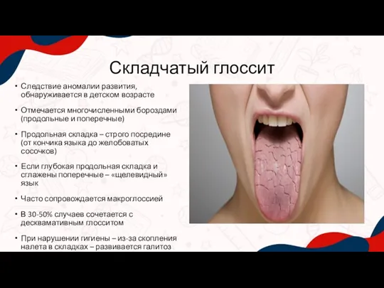 Следствие аномалии развития, обнаруживается в детском возрасте Отмечается многочисленными бороздами (продольные и