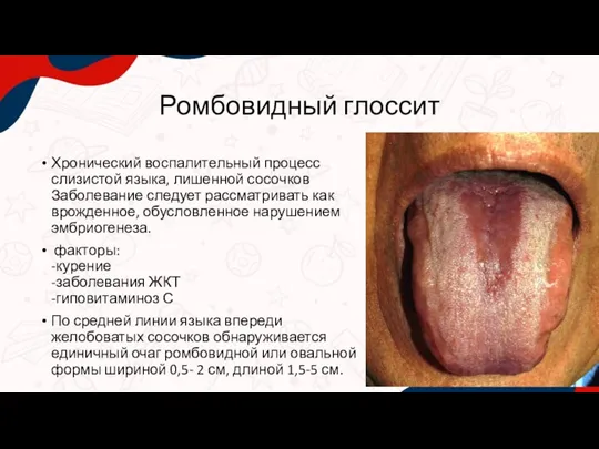 Хронический воспалительный процесс слизистой языка, лишенной сосочков Заболевание следует рассматривать как врожденное,