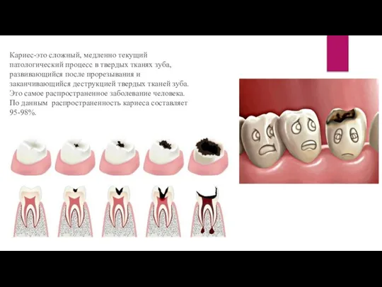 Кариес-это сложный, медленно текущий патологический процесс в твердых тканях зуба, развивающийся после