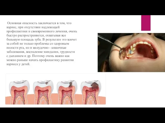 Основная опасность заключается в том, что кариес, при отсутствии надлежащей профилактики и
