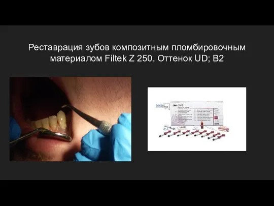 Реставрация зубов композитным пломбировочным материалом Filtek Z 250. Оттенок UD; B2