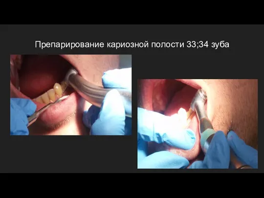 Препарирование кариозной полости 33;34 зуба