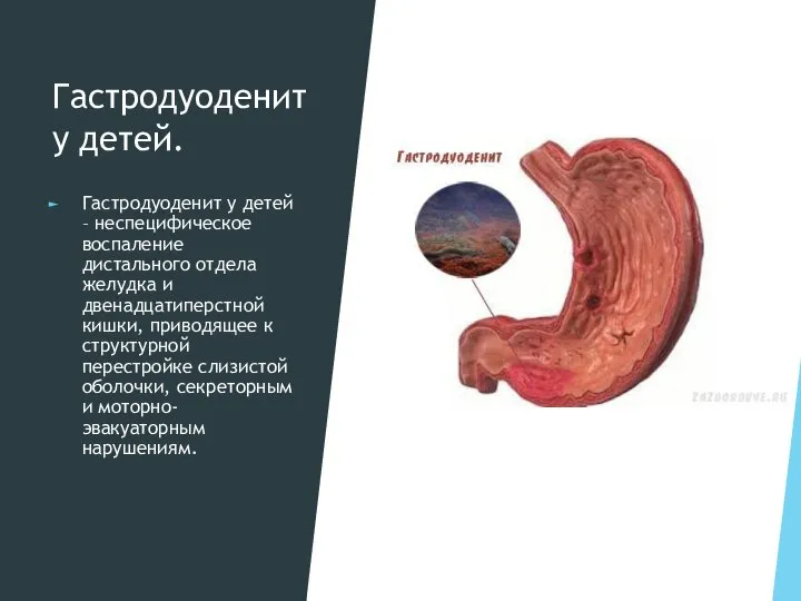 Гастродуоденит у детей. Гастродуоденит у детей – неспецифическое воспаление дистального отдела желудка