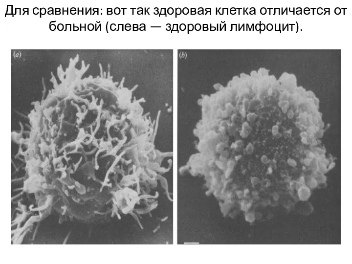 Для сравнения: вот так здоровая клетка отличается от больной (слева — здоровый лимфоцит).