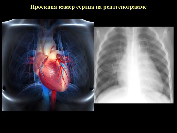 Проекция камер сердца на рентгенограмме