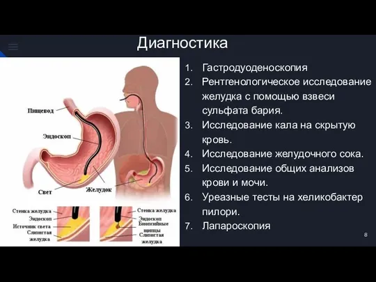 Диагностика Гастродуоденоскопия Рентгенологическое исследование желудка с помощью взвеси сульфата бария. Исследование кала