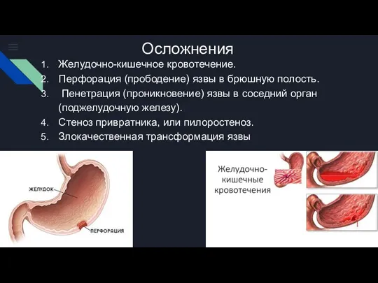 Осложнения Желудочно-кишечное кровотечение. Перфорация (прободение) язвы в брюшную полость. Пенетрация (проникновение) язвы