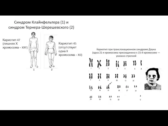 Кариотип 47 (лишняя Х хромосома – XXY) Кариотип 45 (отсутствует одна X хромосома – X0)