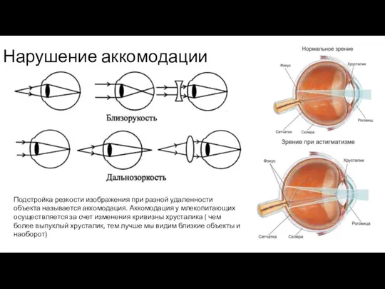 Нарушение аккомодации Подстройка резкости изображения при разной удаленности объекта называется аккомодация. Аккомодация