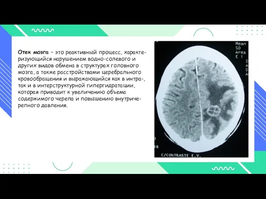 Отек мозга – это реактивный процесс, характе- ризующийся нарушением водно-солевого и других