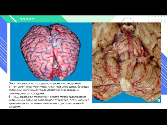 Отек головного мозга с дислокационным синдромом: а - головной мозг увеличен, извилины