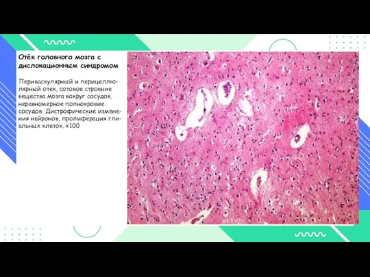 Отёк головного мозга с дислокационным синдромом Периваскулярный и перицеллю- лярный отек, сотовое