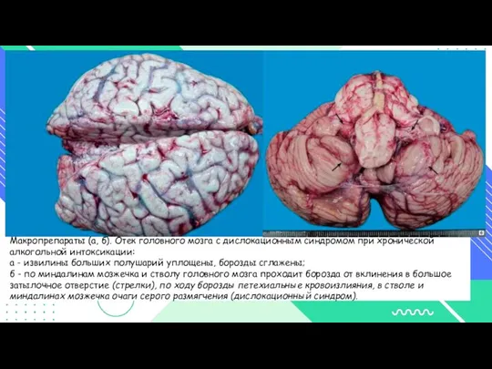 Макропрепараты (а, б). Отек головного мозга с дислокационным синдромом при хронической алкогольной