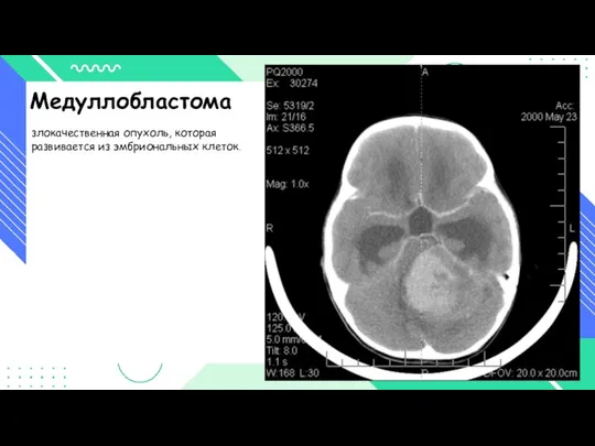 Медуллобластома злокачественная опухоль, которая развивается из эмбриональных клеток.