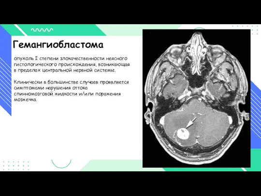 Гемангиобластома опухоль I степени злокачественности неясного гистологического происхождения, возникающая в пределах центральной