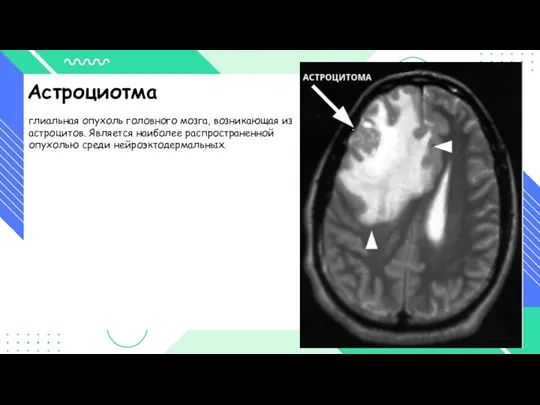 Астроциотма глиальная опухоль головного мозга, возникающая из астроцитов. Является наиболее распространенной опухолью среди нейроэктодермальных.