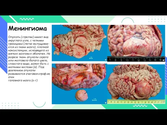 Менингиома Опухоль (стрелки) имеет вид округлого узла, с четкими границами (легко вылущивае-