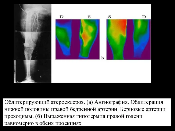 Облитерирующий атеросклероз. (а) Ангиография. Облитерация нижней половины правой бедренной артерии. Берцовые артерии