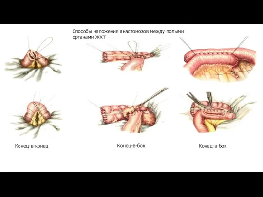 Способы наложения анастомозов между полыми органами ЖКТ Конец-в-конец Конец-в-бок Конец-в-бок