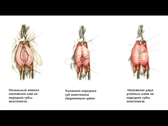 Начальный момент наложения шва на передние губы анастомоза. Ушивание передних губ анастомоза