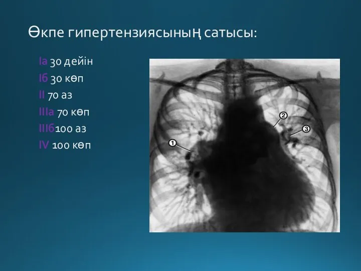 Өкпе гипертензиясының сатысы: Iа 30 дейін Iб 30 көп II 70 аз