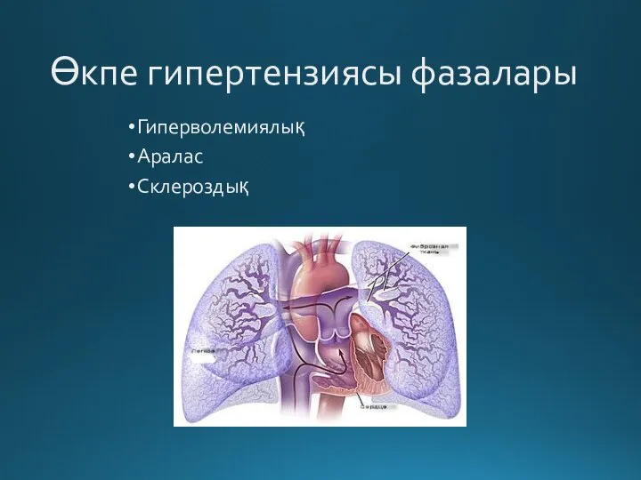 Өкпе гипертензиясы фазалары Гиперволемиялық Аралас Склероздық