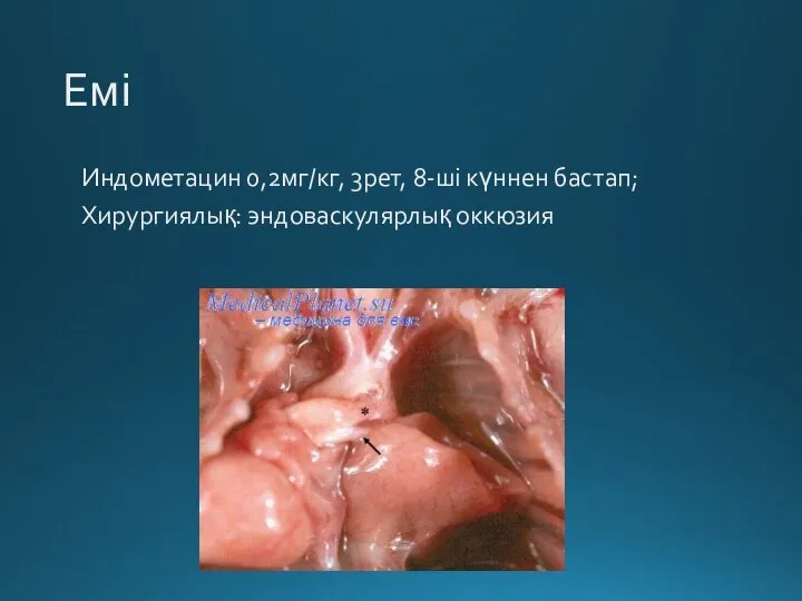 Емі Индометацин 0,2мг/кг, 3рет, 8-ші күннен бастап; Хирургиялық: эндоваскулярлық оккюзия