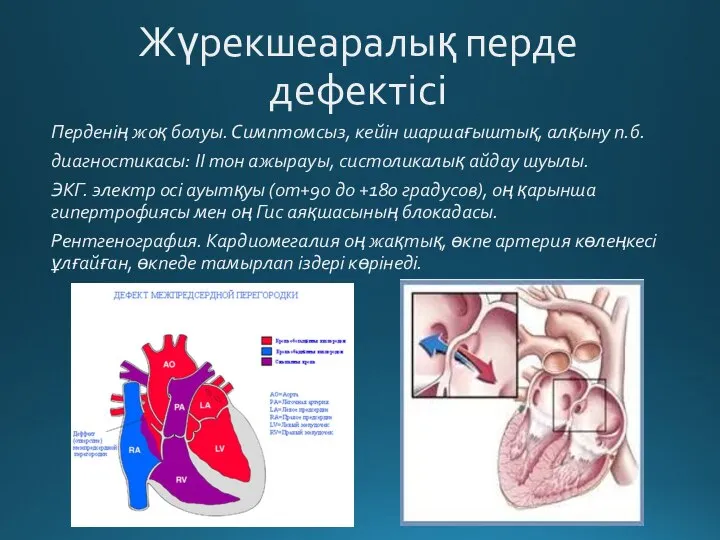 Жүрекшеаралық перде дефектісі Перденің жоқ болуы. Симптомсыз, кейін шаршағыштық, алқыну п.б. диагностикасы: